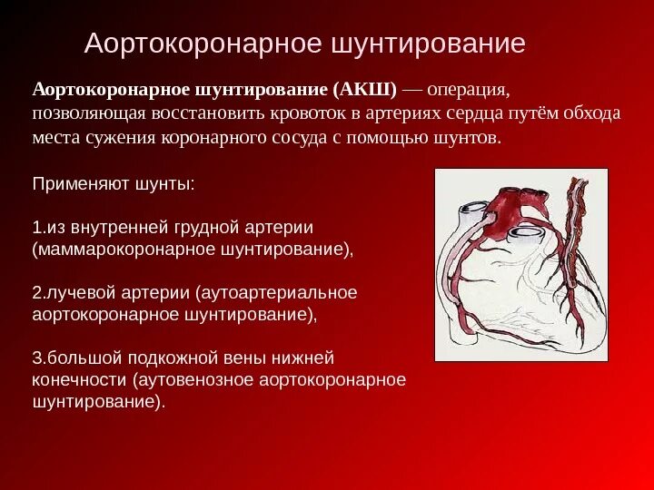 Аортокоронарное шунтирование сосудов. Аорто-коронарное шунтирование. Операции при нарушении коронарного кровообращения.