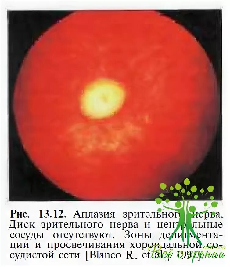 Аплазия диска зрительного нерва. Аплазия зрительного нерва врожденная. Гипоплазия диска зрительного нерва.
