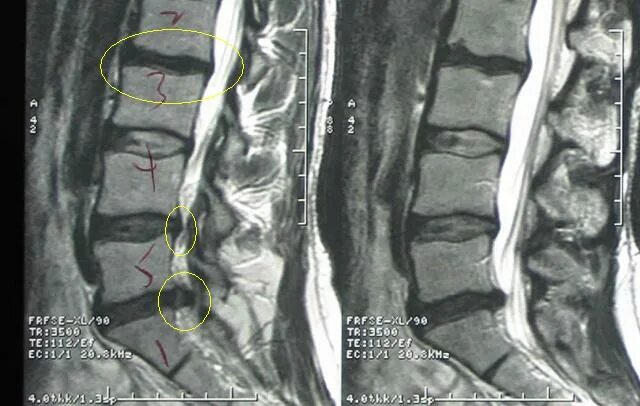 3 4 5 межпозвоночного диска. Межпозвонковые диски l1-l2. Позвоночные диски l2-l3. Протрузия диска l4-s1. Диски l4 s1 позвоночника.