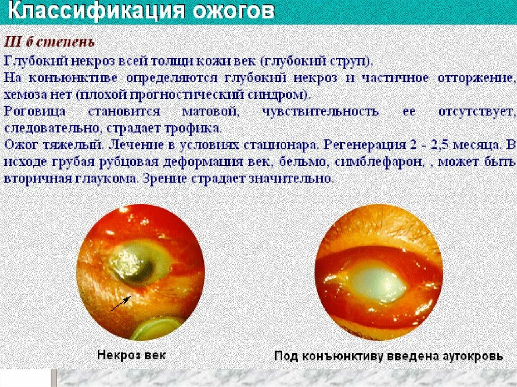 Ожоги глаз классификация. Классификация химических ожогов глаз. Что делать при термическом ожоге глаза