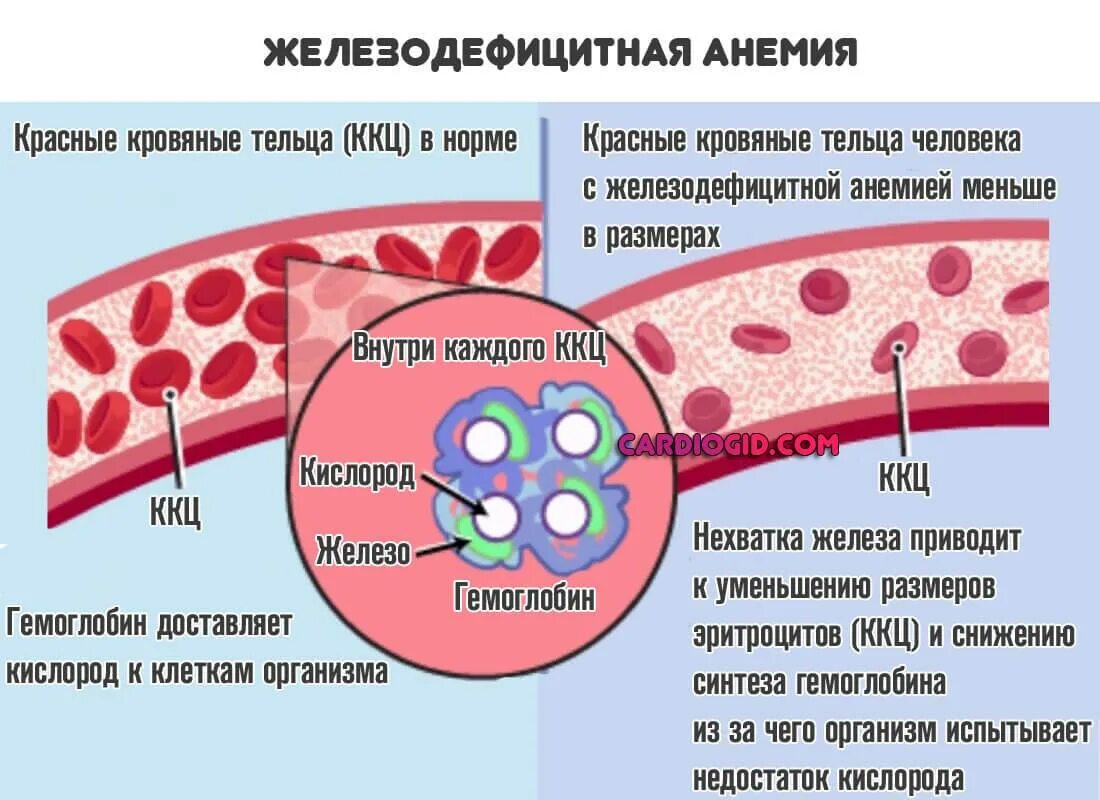 Кровь розовая почему. Железодифицитная Анимия. Железнодефецитная Анимия. Железодефицитная анемия норма. Железодефицитная анемия (жда).