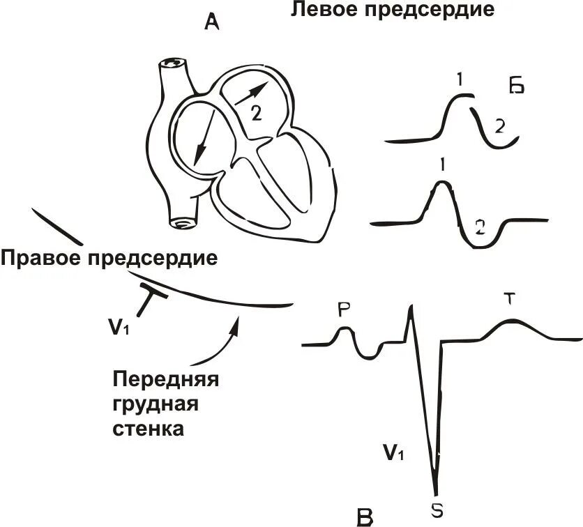 Двухфазный зубец р на ЭКГ. Двухфазный зубец р на ЭКГ В V 1. Двухфазный зубец т в грудных отведениях. Двухфазные зубцы на ЭКГ. Норма правого предсердия