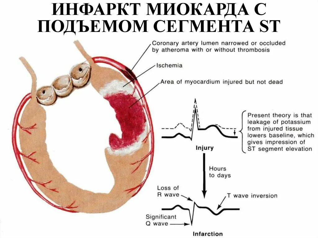 St ишемия. Подъем ст при инфаркте миокарда. Инфаркт миокарда сегмент St. Инфаркт без подъема сегмента St патогенез. Инфаркт миокарда с подъемом сегмента St.