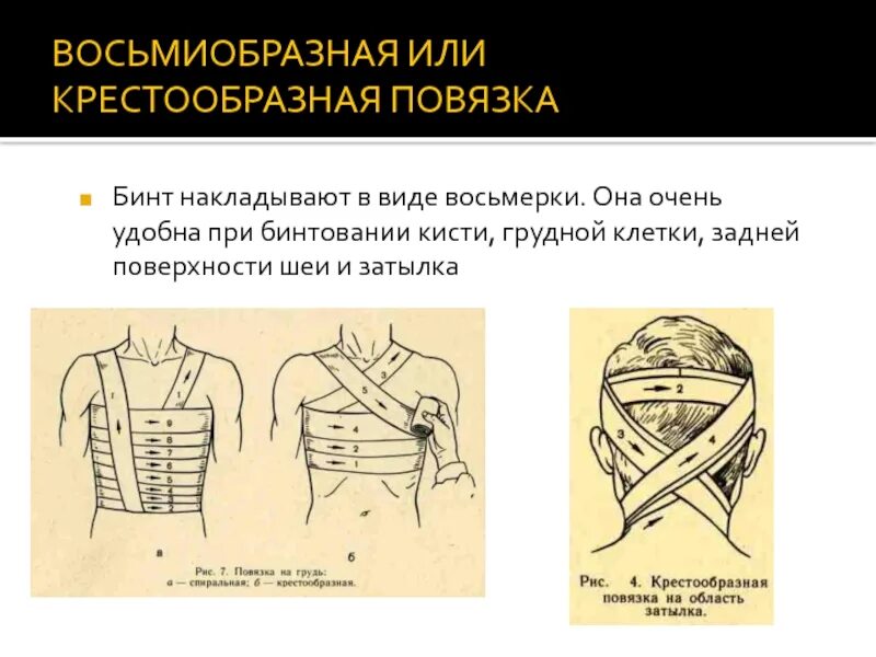 Крестообразная на затылок. Десмургия восьмиобразная повязка. Бинтовые повязки: • крестообразная (восьмиобразная. Восьмиобразная повязка на кисть. Наложение восьмиобразной повязки на грудную клетку.