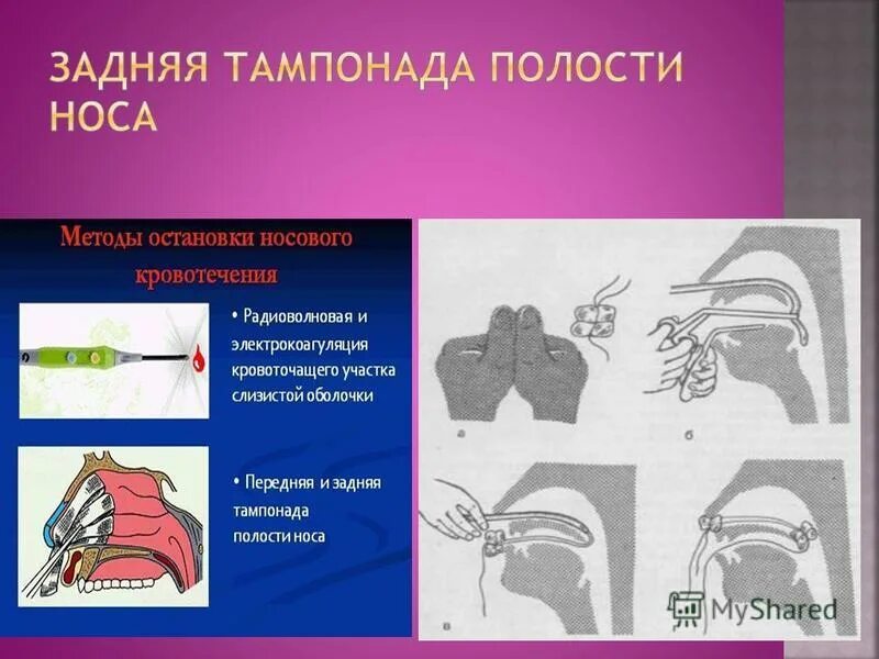 Тампонада носа при носовом кровотечении