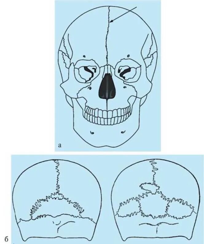 Черепная аномалия. Добавочный шов затылочной кости. Аномалии мозгового черепа. Аномалии развития мозгового черепа.