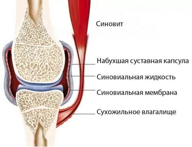 Синовит это. Симптомы синовита коленного сустава. синовит синовиальная оболочка. синовит это воспаление синовиальной оболочки сустава. синовиальная мембрана коленного сустава.