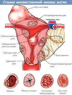 Миома тела матки что это