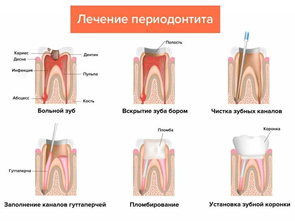 Пульпит тесты с ответами. Хронический периодонтит пульпит. периодонтита 3 канального зуба. хронический фиброзный периодонтит схема. периодонтит зуба симптоматика.
