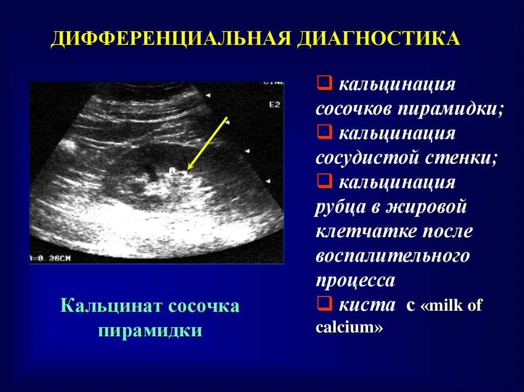 Кальцинаты в почках что это