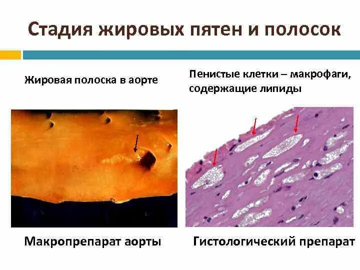 Образование пятен. Препарат атеросклероз аорты патологическая анатомия. Макропрепарат атеросклероза стадии. Атеросклероз аорты патанатомия. Атеросклероз препарат патанатомия.