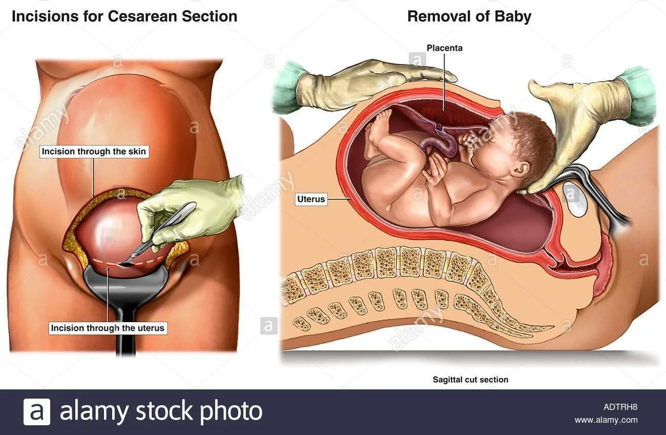 Кесарево когда можно беременеть. Схема кесарева сечения. Кесарево сечение разрез. Рождение ребенка кесарево сечение.