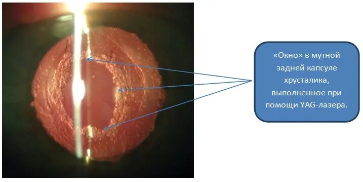 Лазерная дисцизия задней капсулы хрусталика. Вторичная катаракта лазерная дисцизия. Вторичная катаракта фиброз задней капсулы. Вторичная катаракта помутнение задней капсулы. Вторичная катаракта после операции