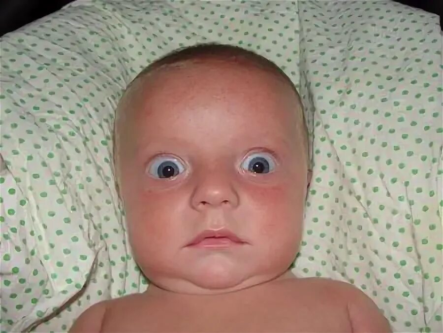 Симптом Грефе у грудничков. Глаза новорожденного ребенка.