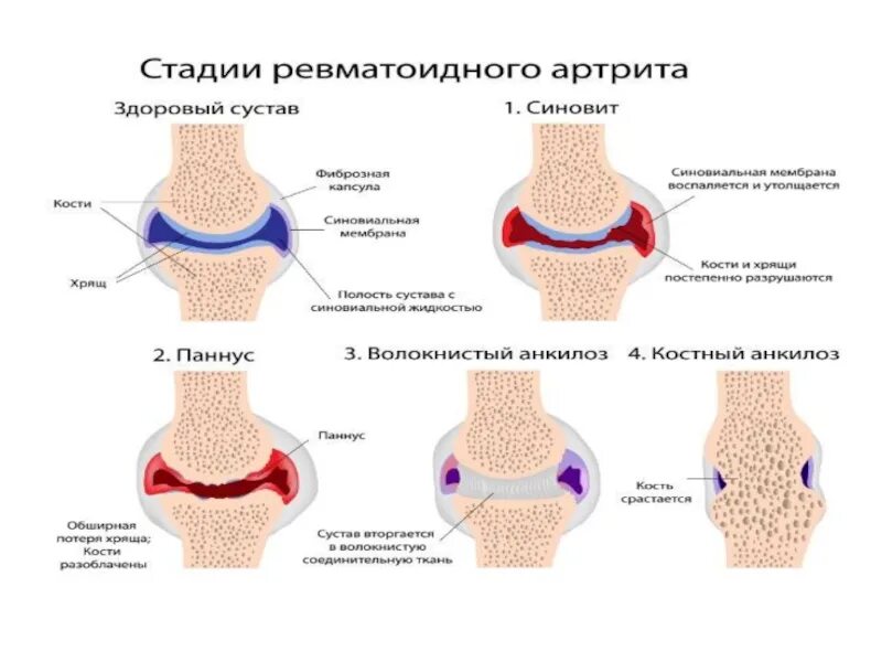 Ревматоидный артрит это. Pannus ревматоидный артрит. Синовит ревматоидный артрит. Осложнения ревматоидного артрита анкилоз. Стадии ревматоидного артрита паннус.