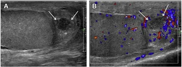 Эпидидимит УЗИ картина. Хронический орхит УЗИ признаки.