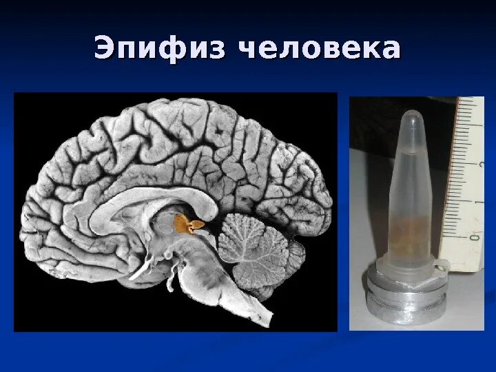 Шишковидная железа. Эпифиз мозга анатомия. Шишковидная железа анатомия. Эпифиз шишковидная железа. Эпифиз или шишковидное тело.