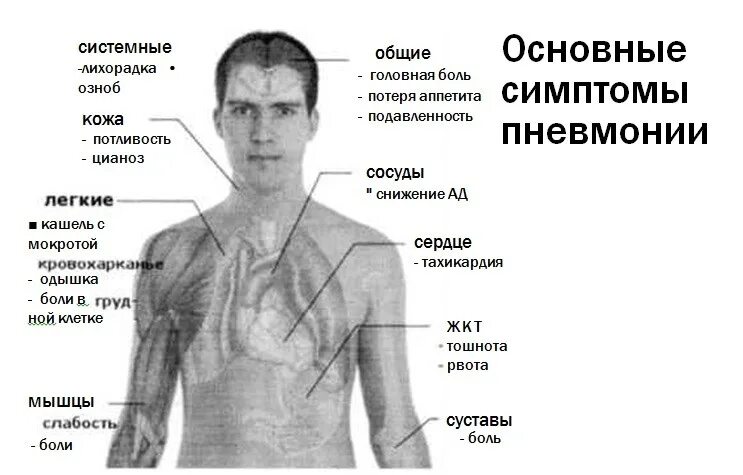 Боль при воспалении легких. Где болит при воспалении легких. Симптомы при пневмонии у взрослых. Какие боли при пневмонии