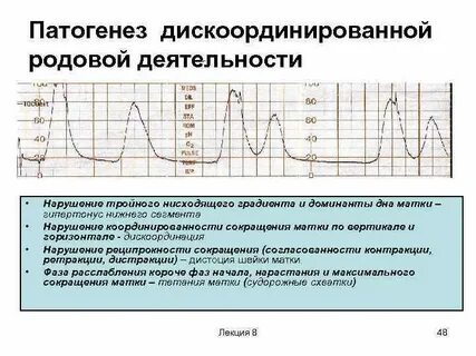 Сокращение матки при беременности