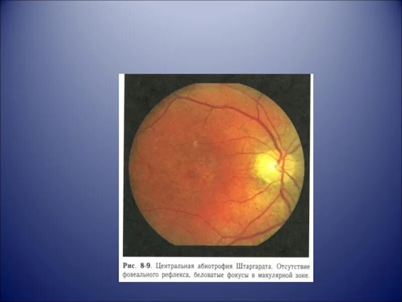 Эпиретинальный фиброз глаза. Эпиретинальный фиброз сетчатки глаза. Метод исследования зрительного нерва. Патология сетчатки и зрительного нерва. Методы исследования патологии сетчатки и зрительного нерва.
