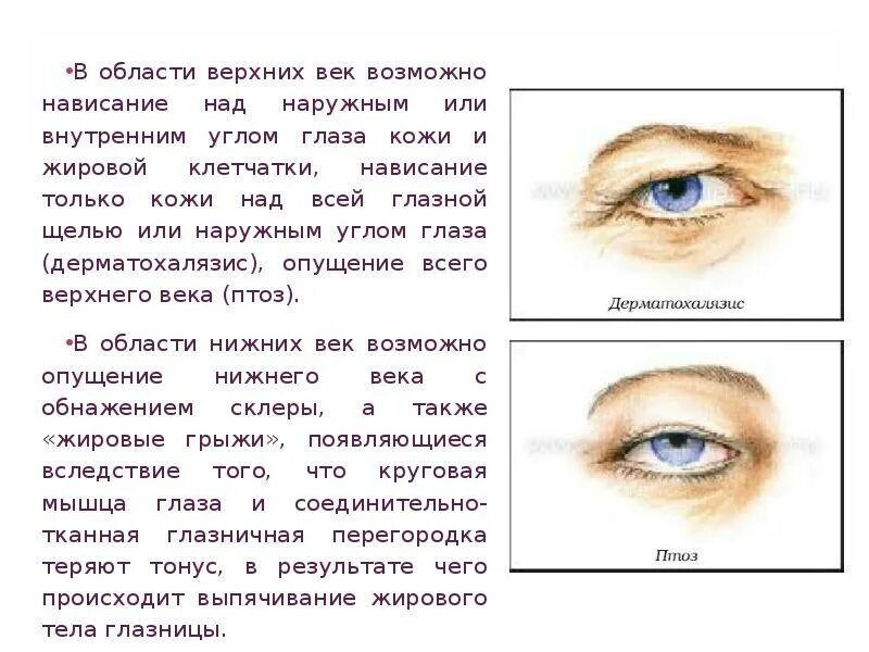 Птоз века левого глаза. Односторонний птоз верхнего века причины. Птоз верхнего века степени. Причины дергания глаза верхнего века. Дергается верхнее веко глаза примета