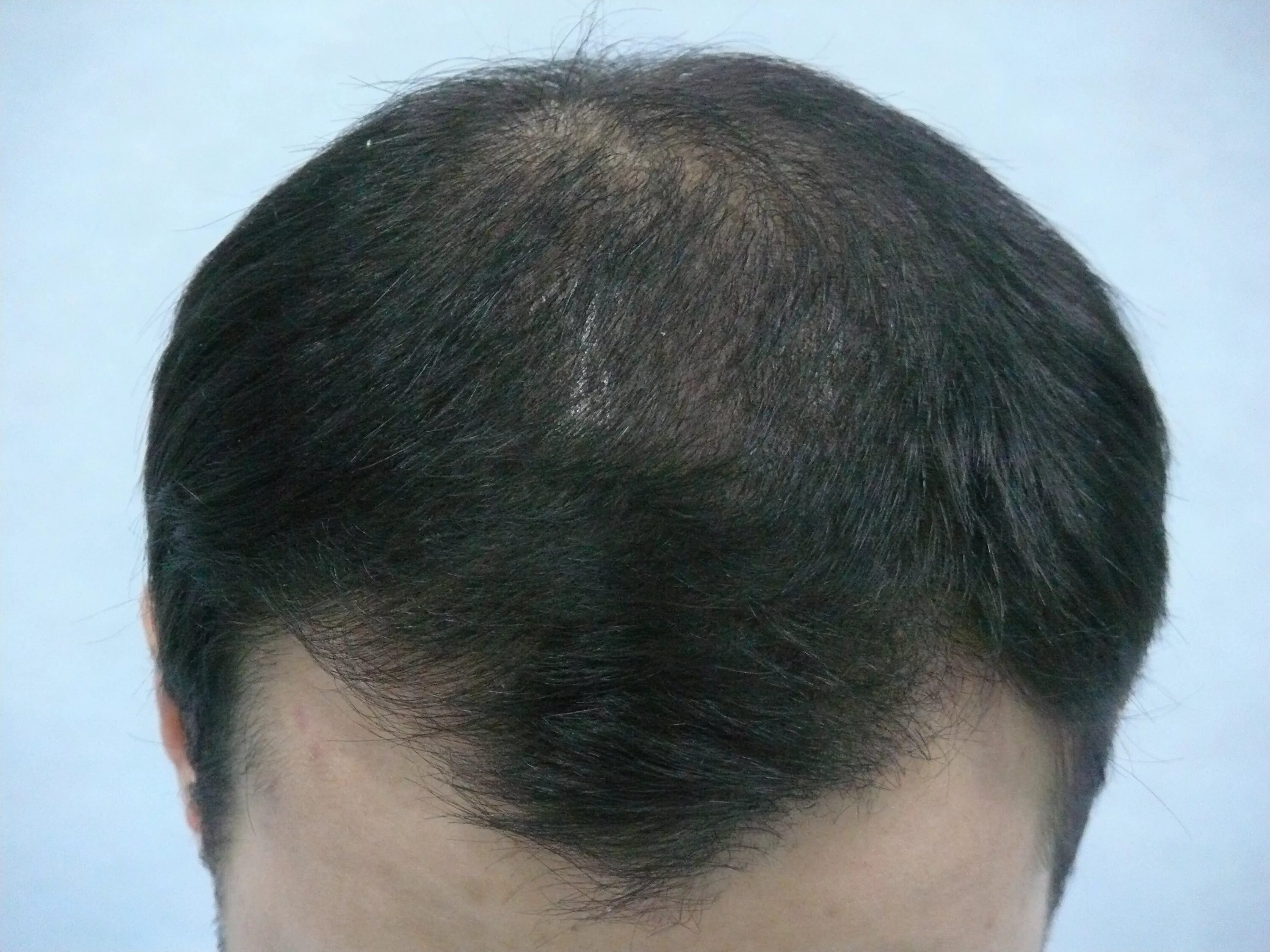 Выпадение волос у мужчин лечение. Сифилитическая алопеция. Сифилитическое облысение.