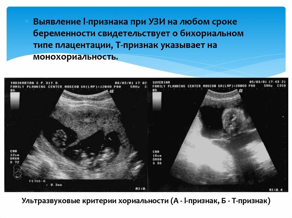 Маловодие 20 неделя. Признаки хориальности на УЗИ. Т признак УЗИ при многоплодной беременности. Многоводие УЗИ картина.