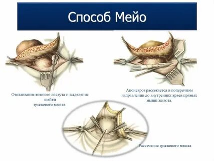 Пупочная грыжа методы операции