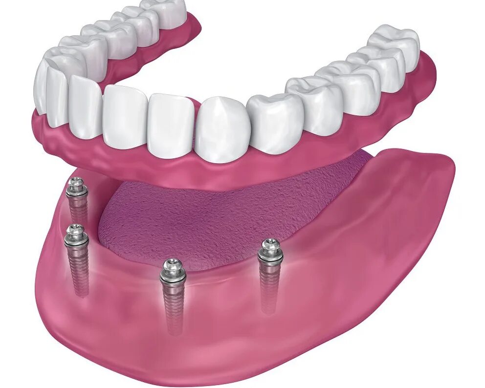Протез на имплантах на шаровидных абатментах. Несъемный мостовидный протез на 4 имплантах. Несъемный мостовидный протез на 6 имплантах. 4 зуба съемные. 4 зуба съемные.