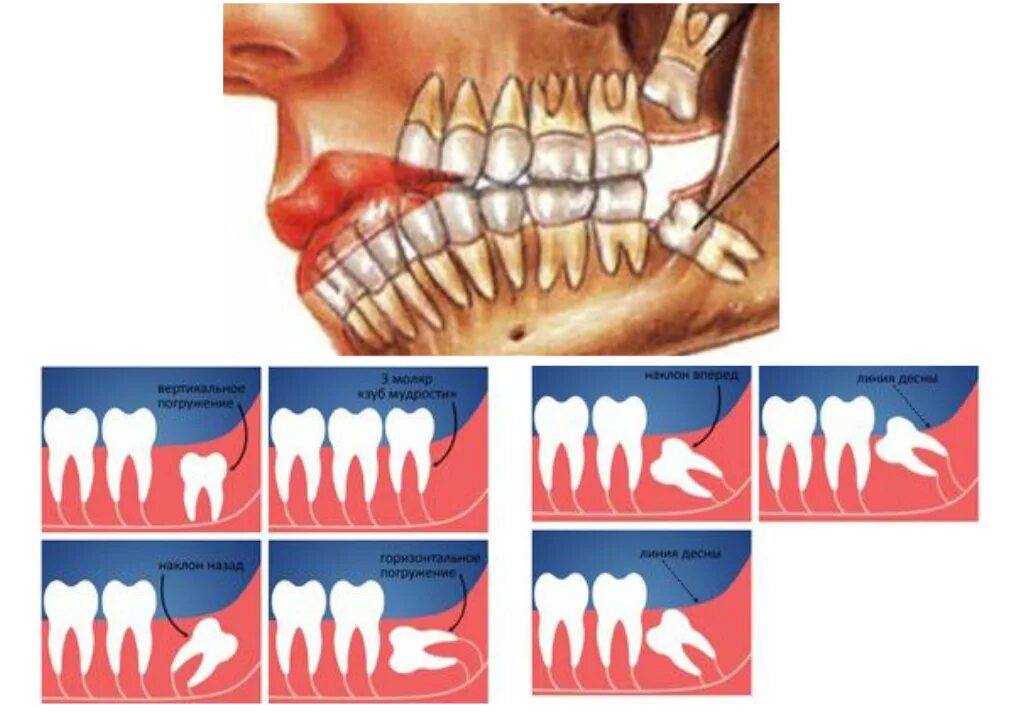 Вырывание зуба мудрости. Как долго растут зубы мудрости