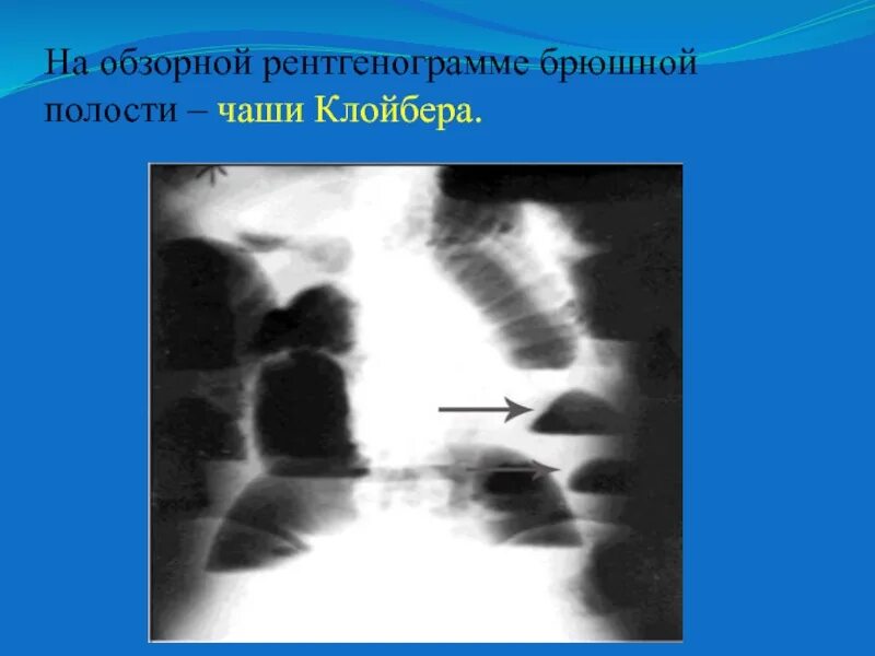 Клойбера на рентгенограмме