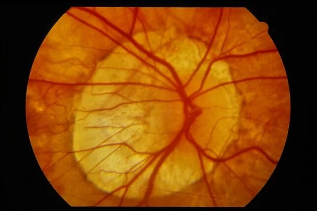 Миопический конус. Миопический конус глазное дно. Стафилома диска зрительного нерва. Миопическая стафилома сетчатки. Миопическая стафилома склеры.