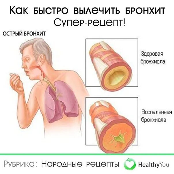 Тяжести мокроты. Гнойный бронхит мокрота. Гнойно слизистая мокрота. Слизисто гнойная мокрота.