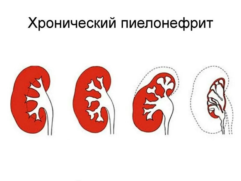 Пиелит это. Хронический пиелонефрит. Хроничечки йпиелонефрит. Хронический пиелонефрит почек.