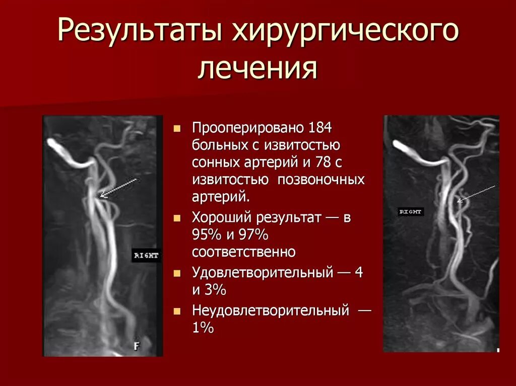 Изгиб вса. Извитость сонных артерий кинкинг. Патологическая извитость сонных артерий койлинг. Патологическая извитость сосудов шеи. S-образная извитость внутренней сонной артерии.