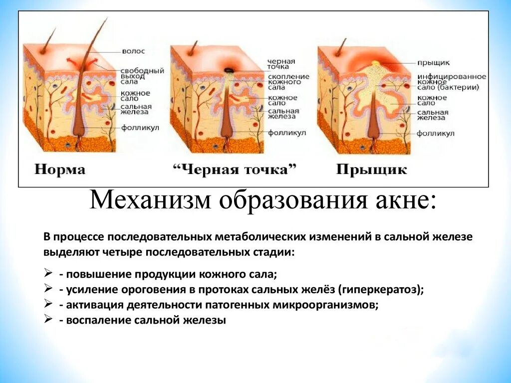 Механизм формирования акне. Кожа акне и сальные железы. Кожное заболевание акне. Акне, папуло-пустулезная форма средней степени тяжести. Почему бывают прыщи