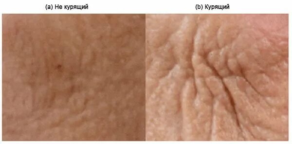 Борозды на коже. Кератодермия гиперкератоз. Ониходистрофия - онихолизис. Кожа человеческая. Ногти поперечные борозды бо (линии бо-рейля).