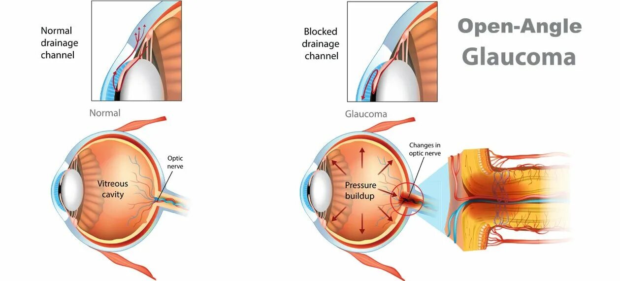 Факотопическая глаукома. Open Angle Glaucoma. Неопластическая глаукома. Кистозная фильтрационная подушка глаукома. Глаукома латынь