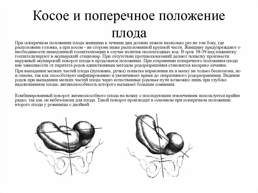 Тактика ведения при поперечном положении плода. Ведение родов при поперечном и косом положении плода. Поперечное положение плода позиция. Поперечные и косые положения плода акушерская тактика. Позиция плода при поперечном положении