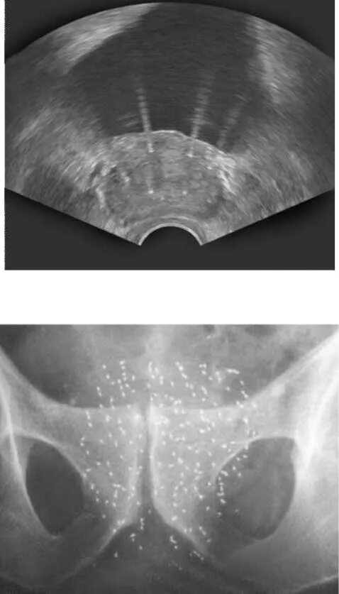 Брахитерапия предстательной железы. Брахитерапия предстательной железы на УЗИ. Брахитерапия простаты цена