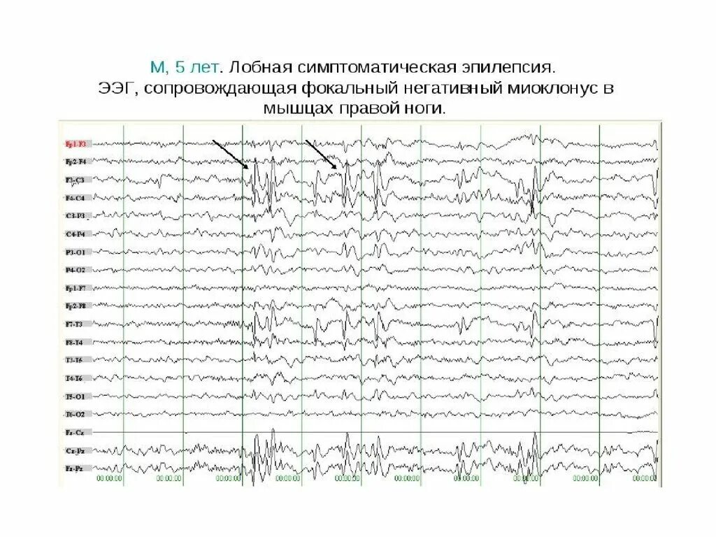 Сколько длится ээг. Норма ЭЭГ У ребенка 3 года. ЭЭГ патология. ЭЭГ норма у детей 4 лет. ЭЭГ головного мозга норма.