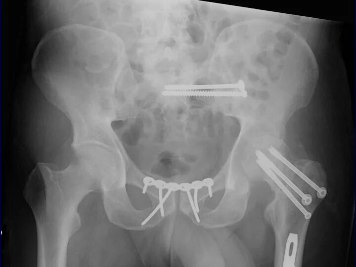Перелом подвздошной кости рентген. Перелом таза остеосинтез. Ванночка для подмывания. Перелом таза остеосинтез. Остеосинтез при переломе таза.