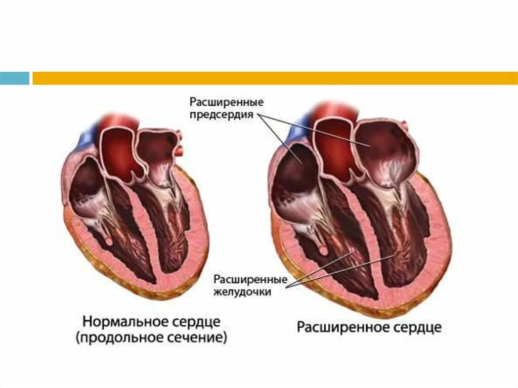 Сердце расширение в право. Расширение левого предсердия причины. Ишемия левого желудочка сердца. Дилатация предсердий и желудочков. Тень сердца расширена в поперечнике.