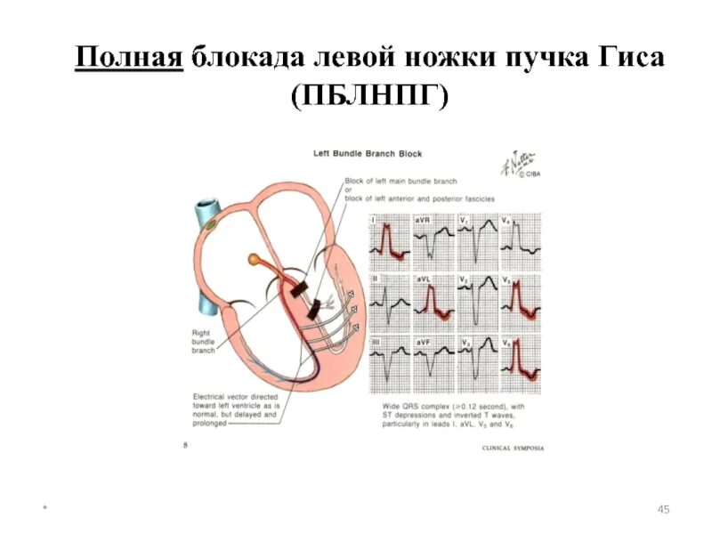 Блокада сердца ножки гиса. Блокада пучка Гиса 1576. Блокада левой ветви пучка Гиса. ФП И блокада левой ножки пучка Гиса. Полная блокада левой ножки пучка Гиса.