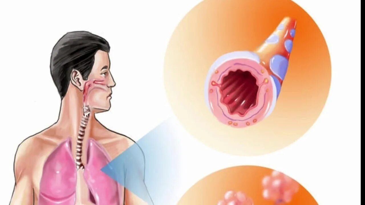 Бронхит у человека. Острый бронхит и бронхиальная астма. Бронхит астма.