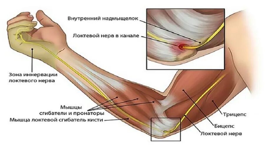 Невропатия локтевого нерва лечение. Неврит (невропатия) локтевого нерва.. Неврит локтевого нерва ЛФК. Бурсит локтевого сустава анатомия. Нейропатия локтевого нерва клиника.