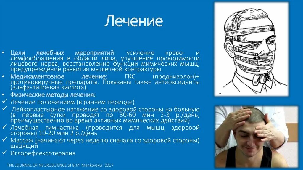 Контрактура мышц при неврите лицевого нерва. Клинические проявления неврита лицевого нерва. Лекарства при парезе лицевого нерва.