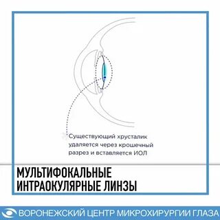 Мультифокальный хрусталик