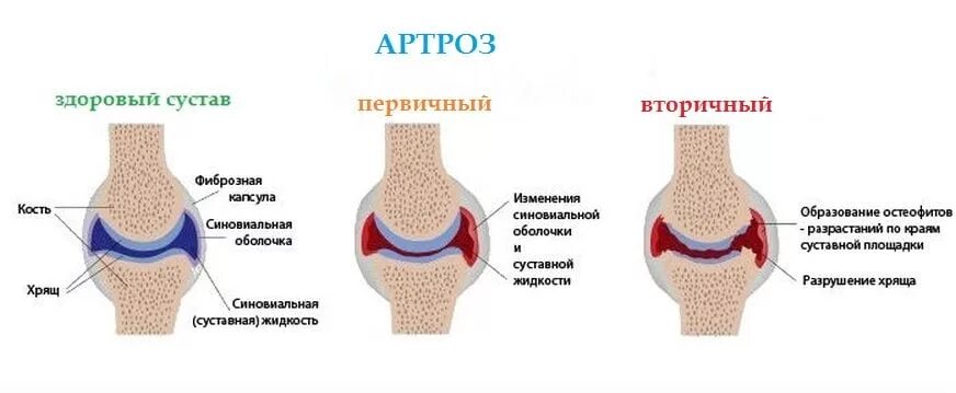 Остеоартрит коленного сустава симптомы. Первичный остеоартрит коленного сустава. Первичный и вторичный остеоартроз. Схема развития деформирующего остеоартроза. Изменение формы сустава