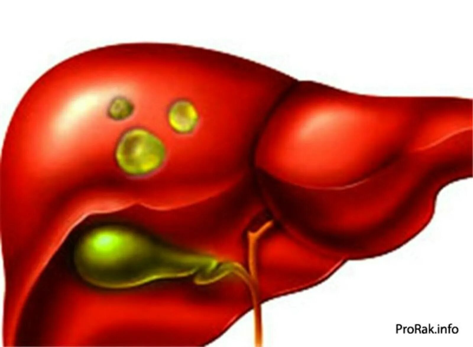 Киста печени причины возникновения у женщин. Поликистоз печени непаразитарная. Непаразитарные кисты печени. Паразитарная киста печени.